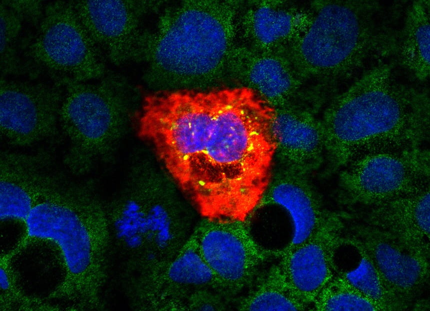 Immunofluorescence of a Caco-2 cell infected with astrovirus VA1 (red). eIF3A is stained in green. Stress granules containing eIF3A are induced upon infection (yellow). Nuclei stained with DAPI (blue)